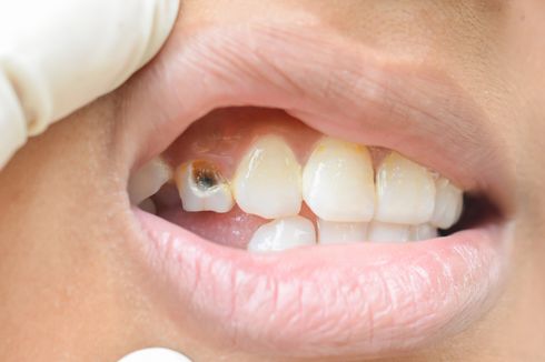 Dokter RSND Undip: Seperti Ini Cara Merawat Gigi Terinfeksi