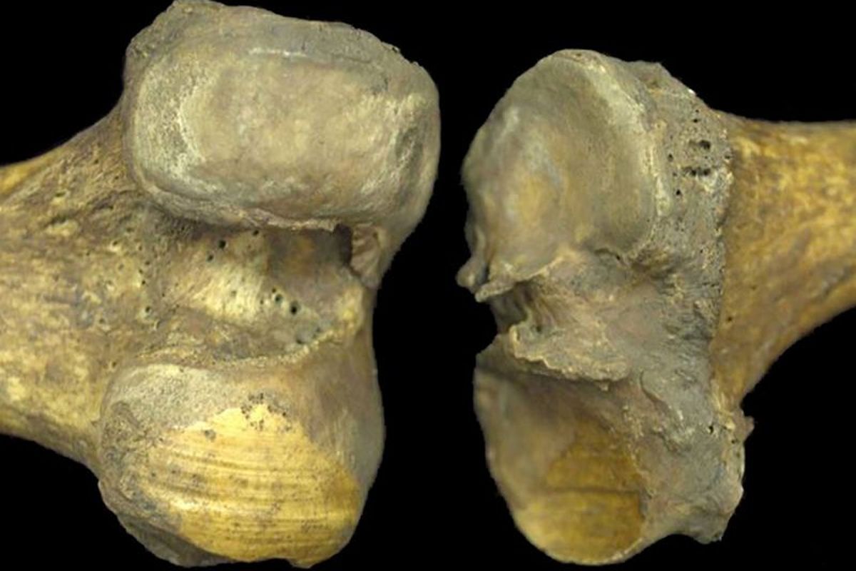 Lutut kuno yang menunjukkan bukti-bukti gesekan antara tulang akibat artritis.