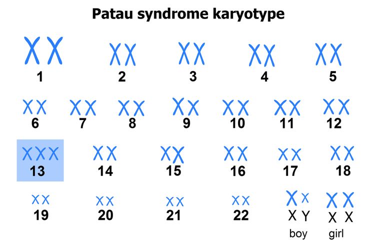 Ilustrasi sindrom Patau