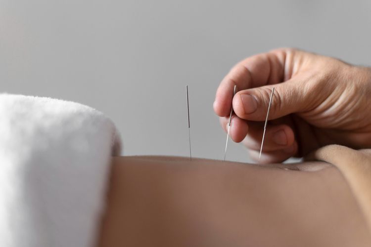 Ilustrasi akupuntur