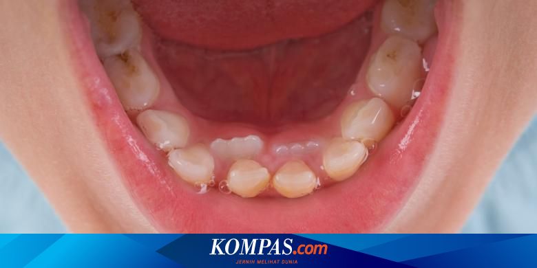 Mencabut Gigi Anak Yang Berjejal