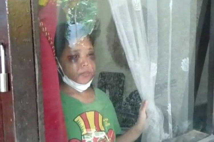 Seorang ART yang diduga disekap dan disiksa majikannya di Kabupaten Bandung Barat. 

