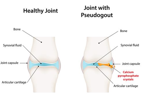 Pseudogout 