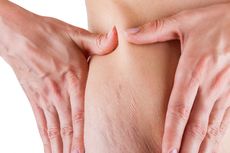 8 Penyebab Stretch Mark di Paha dan Cara Menghilangkannya