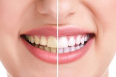 3 Cara Menghilangkan Plak Gigi Secara Alami