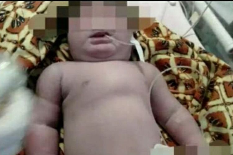 Kondisi bayi dengan mata satu dan tanpa hidung di RSUD Siak.