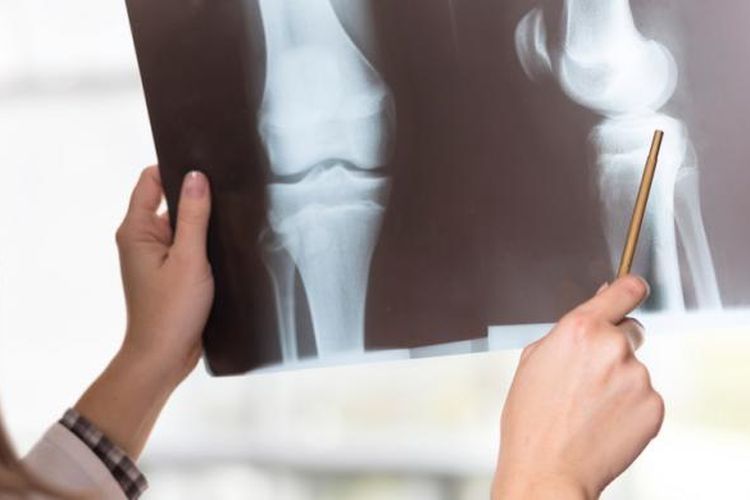Ilustrasi hasil rontgen orang yang terkena osteoporosis.