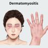Ciri-ciri Penyakit Autoimun Kulit Dermatomiositis
