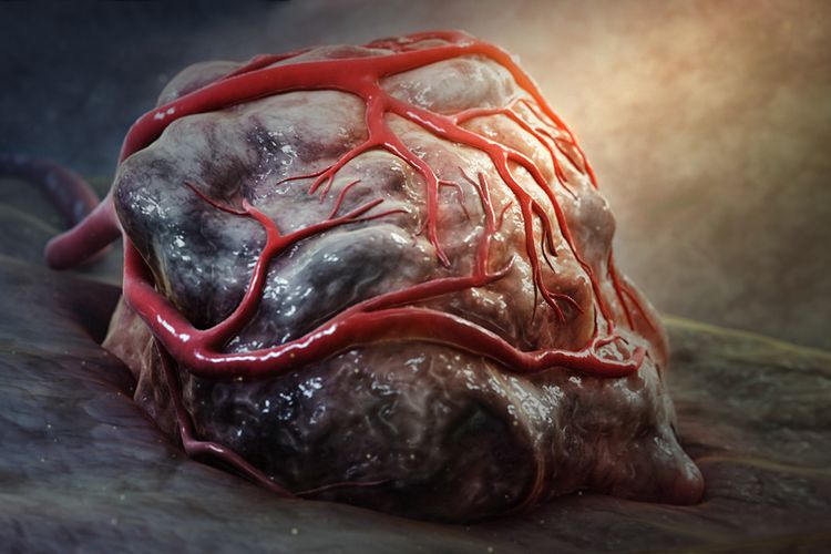 Ilustrasi tumor.