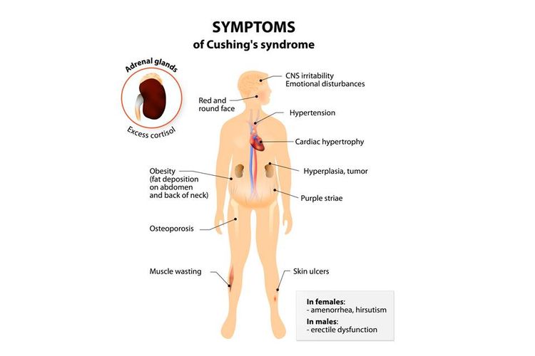 Cushing syndrome