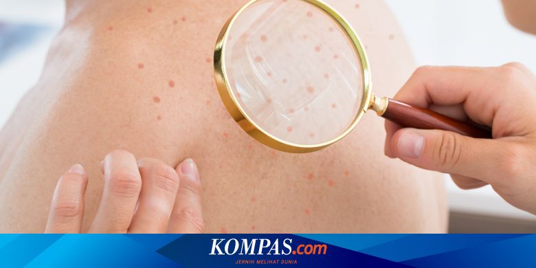 Mengenal Jerawat Punggung, Penyebab hingga Pengobatannya