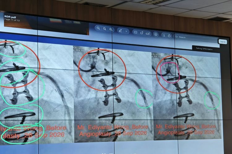 Dokter Singapura Sebut Kawat 21 Cm Bersarang di Jantung Ediyanto Berbahaya, Keluarga Bimbang Operasi