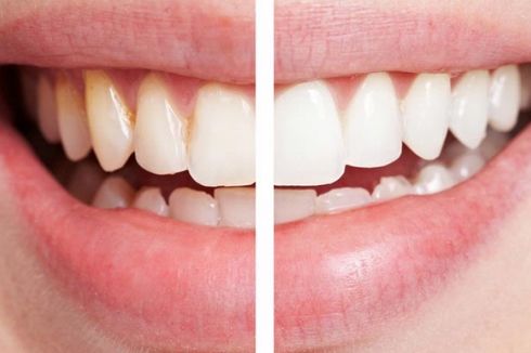 5 Langkah Mudah Memutihkan Gigi dari Rumah