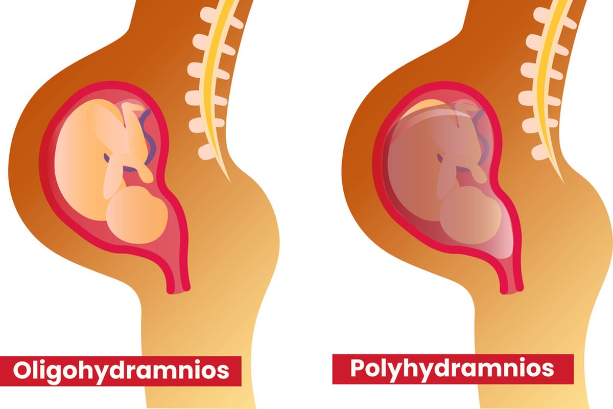 Ilustrasi Polihidramnion dan Oligohidramnion