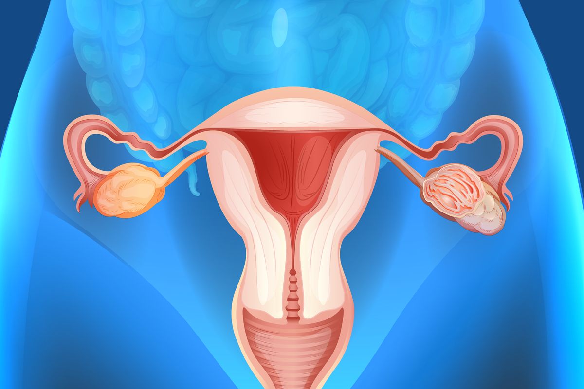 Ilustrasi ovarium. Ovarium merupakan bagian penting dari sistem reproduksi wanita. Bagian ini berperan untuk mengatur siklus menstruasi dan kehamilan.