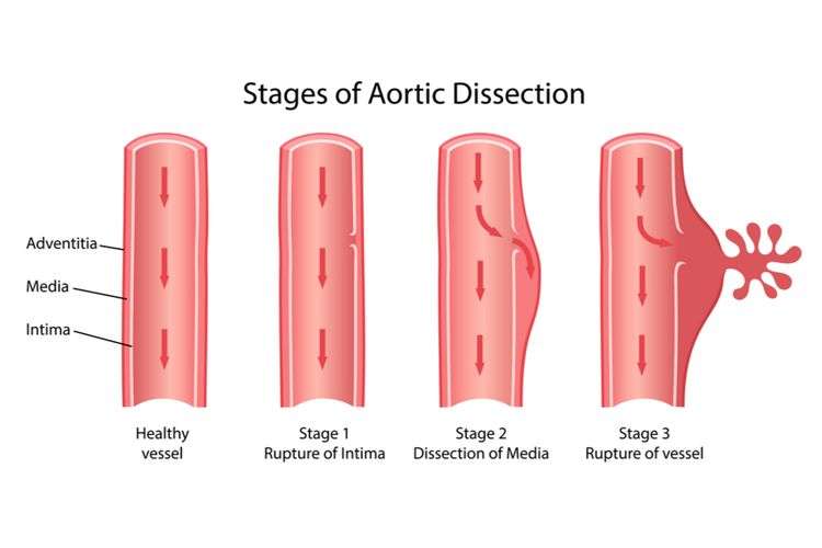 Ilustrasi diseksi aorta