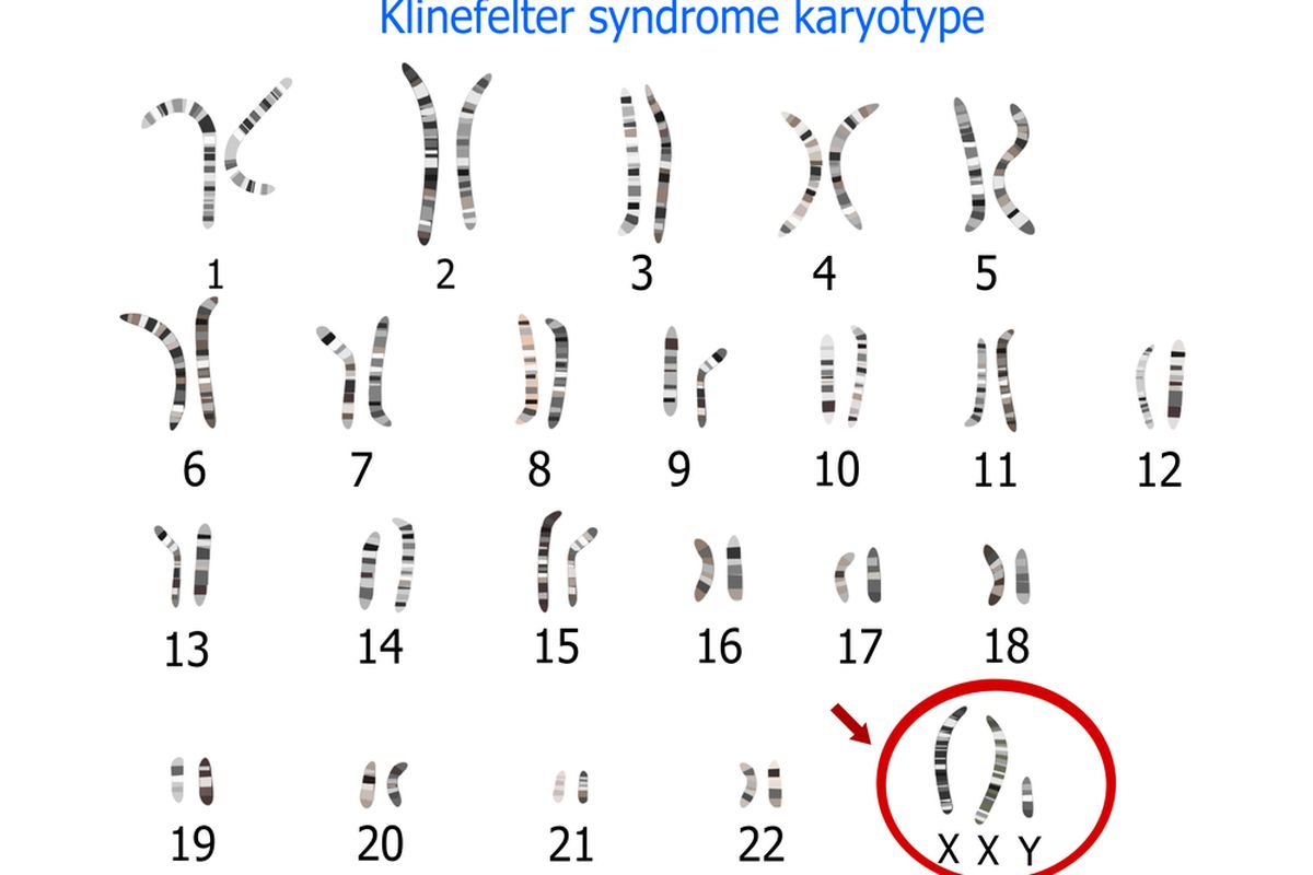 Ilustrasi Sindrom Klinefelter