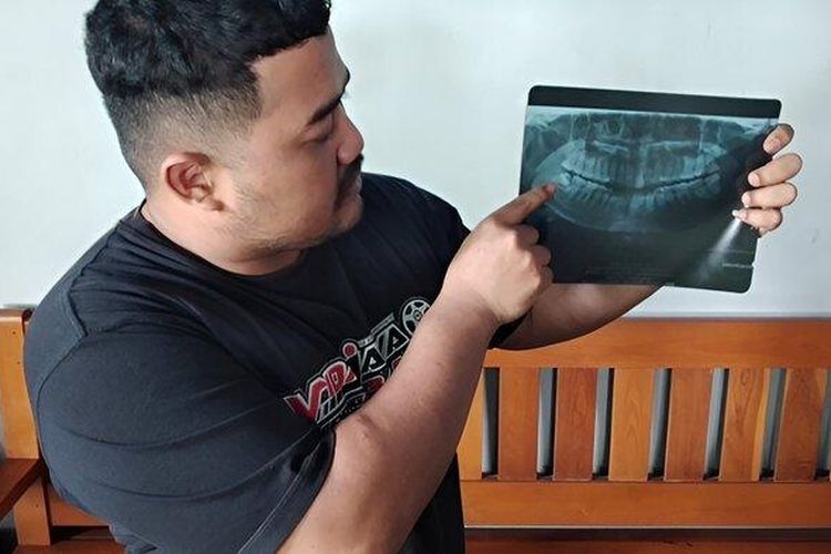 Davin Ahmad Sofyan (28) menunjukkan foto rontgen gigi bungsu milik istri tercintanya Nira Pranita Asih (31) sebelum dicabut hingga mengakibatkan infeksi mulut di Desa Gendingan, Kecamatan Widodaren, Kabupaten Ngawi, Jatim, Rabu (8/5/2024).  (Surya/Febrianto Ramadani)