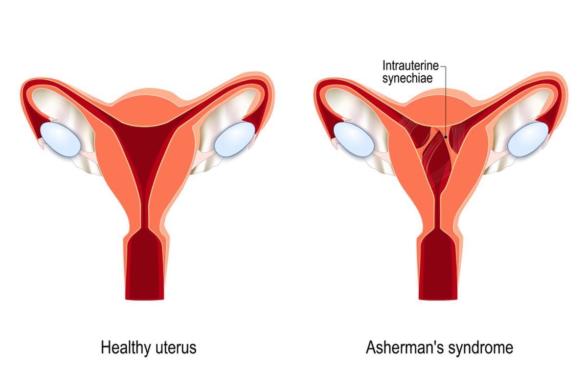 Ilustrasi Asherman's Syndrome