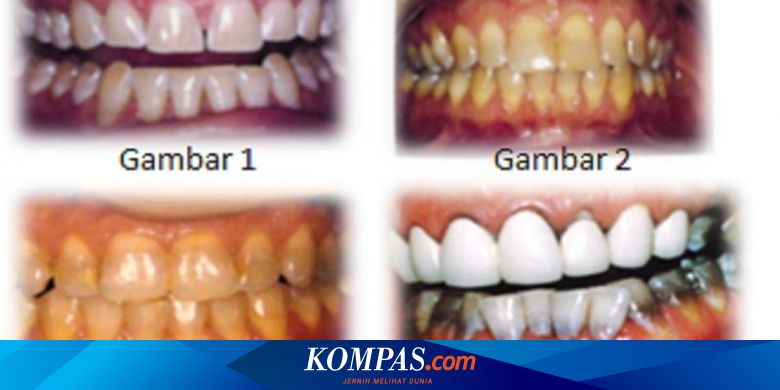 Gigi Kuning akibat Antibiotik Halaman all - Kompas.com