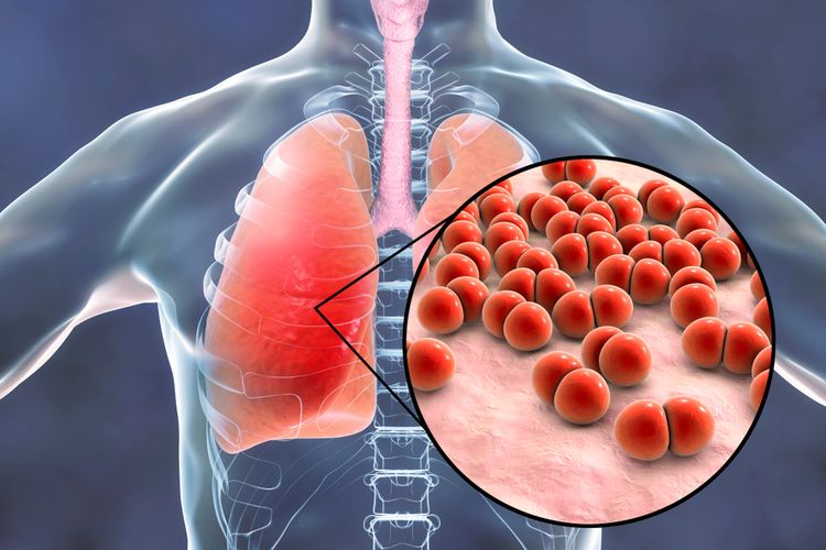 Pneumonia terdiri dari empat tahap perkembangan infeksi, yaitu kongesti, hepatisasi merah, hepatisasi abu-abu, dan resolusi.