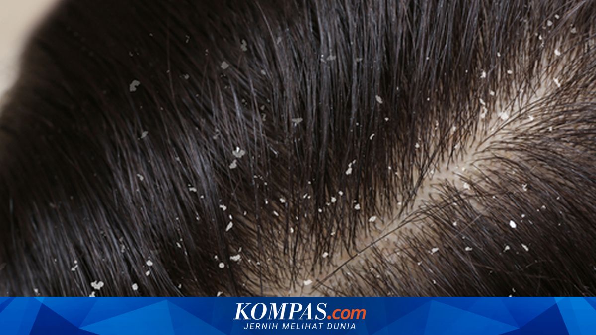 Cara Menghilangkan Ketombe Menurut Ahli, Jangan Asal Pakai Minyak Rambut