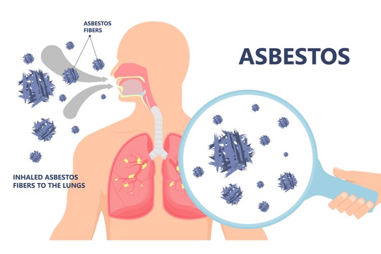 Ilustrasi asbestosis