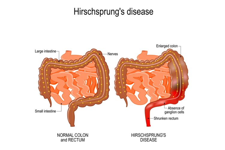 Ilustrasi Penyakit Hirschsprung