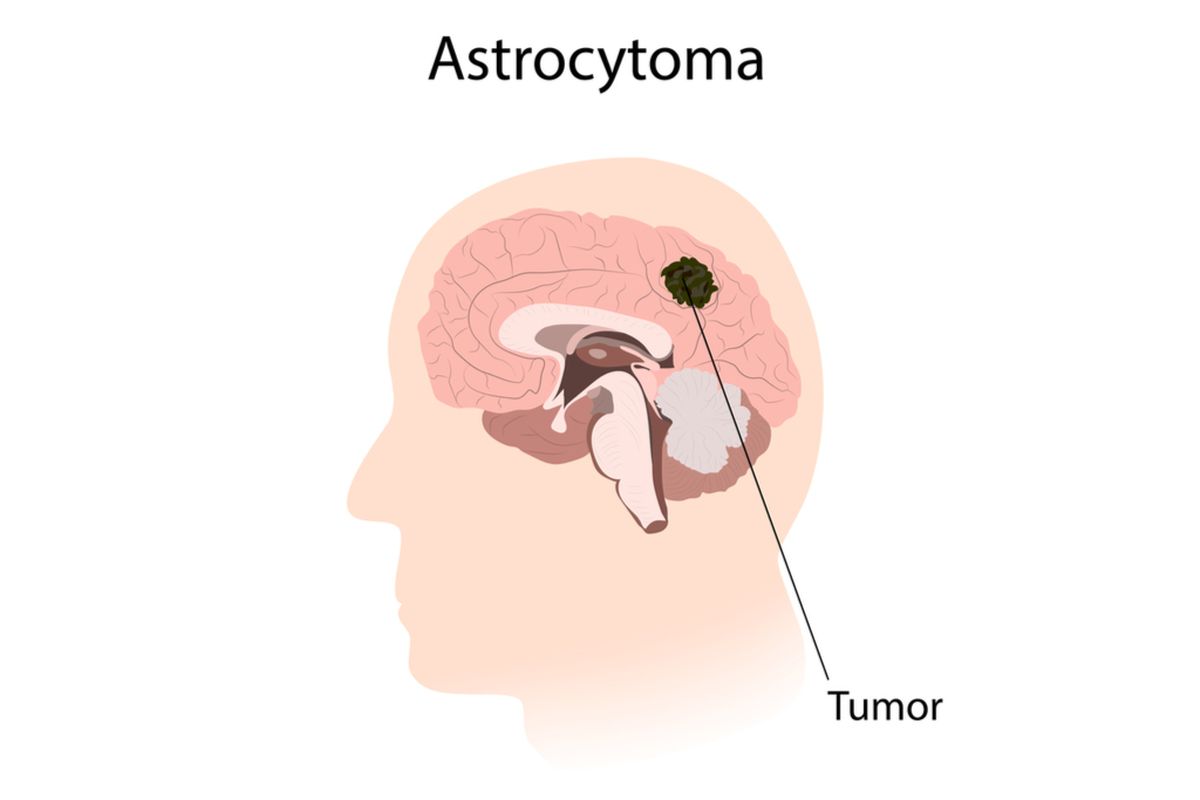 Ilustrasi astrositoma