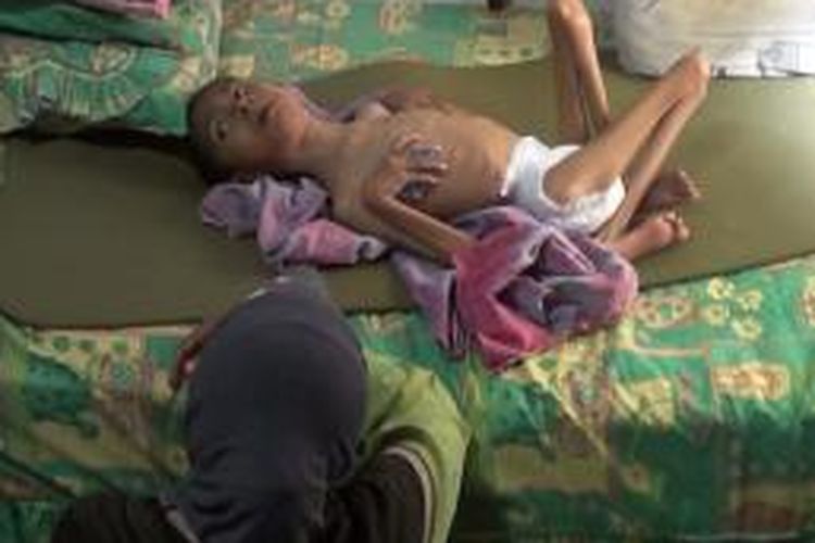 Derita Bocah Gizi Buruk, Azhar bocah penderita gizi buruk mengharapkan bantuan untuk penyembuhannya. Keluarganya tidak mampu mengobati Azhar karena kemiskinan