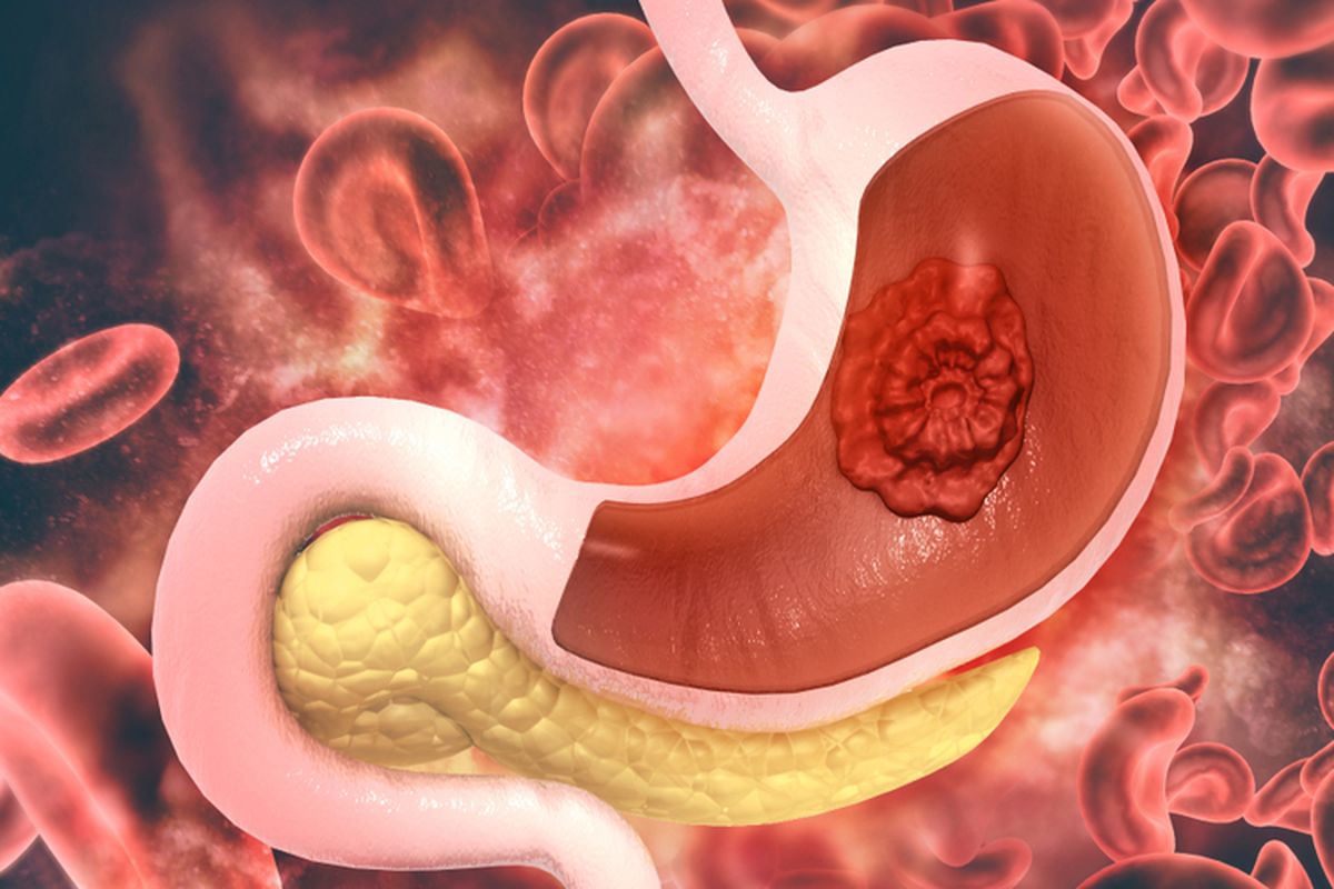 Ilustrasi kanker lambung. Seringkali gejala kanker lambung dianggap sebagai maag basa atau GERD.