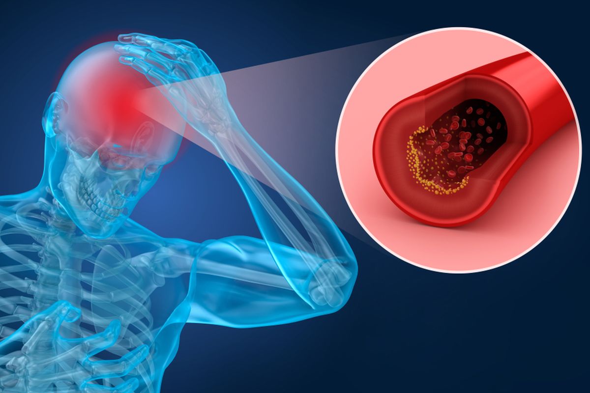 Penyebab stroke ringan yang utama adalah adanya gumpalan darah di arteri menuju otak. Ini bisa dipengaruhi oleh kolesterol tinggi dan hipertensi.