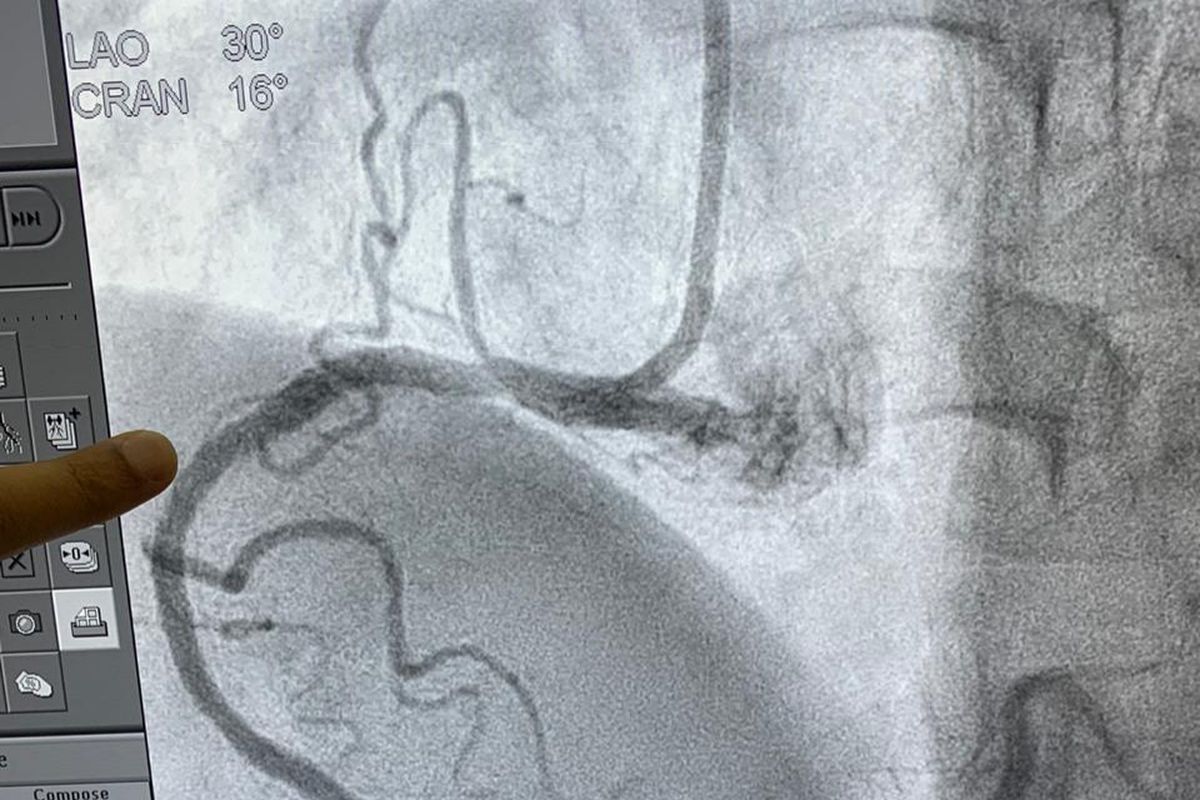 Gambar pembuluh darah pasien setelah dipasang ring jantung di RSUD Soekarno Babel.
