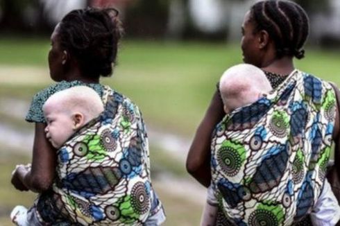 Ramai soal Bocah Albino di Wonogiri, Apa Penyebabnya dan Bisakah Disembuhkan?