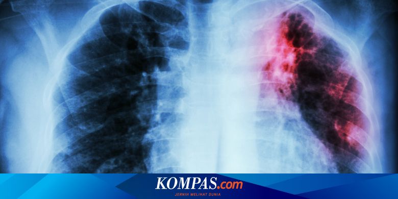 Perencanaan Global Diharapkan Akhiri Epidemi Tbc Pada 2030 Halaman All Kompas Com