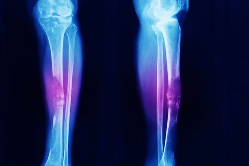 12 Jenis Penyakit Tulang dan Gejalanya yang Harus Diwaspadai