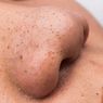 5 Skincare Penghilang Komedo, dari Asam Salisilat sampai Retinol