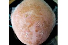 Keratosis Aktinik (Solar Keratosis)