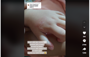 Ramai soal Cacing Masuk ke Dalam Kulit Tangan Bocah, Penyakit Apa ...