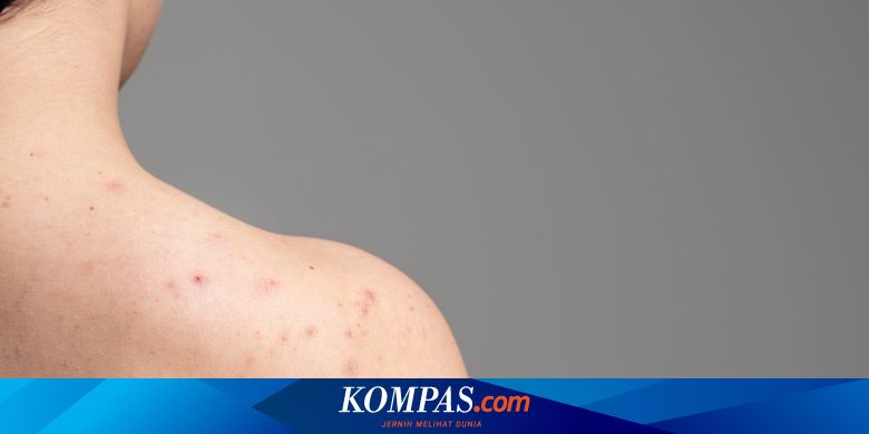 8 Cara Menghilangkan Jerawat di Punggung - Vimarsana News