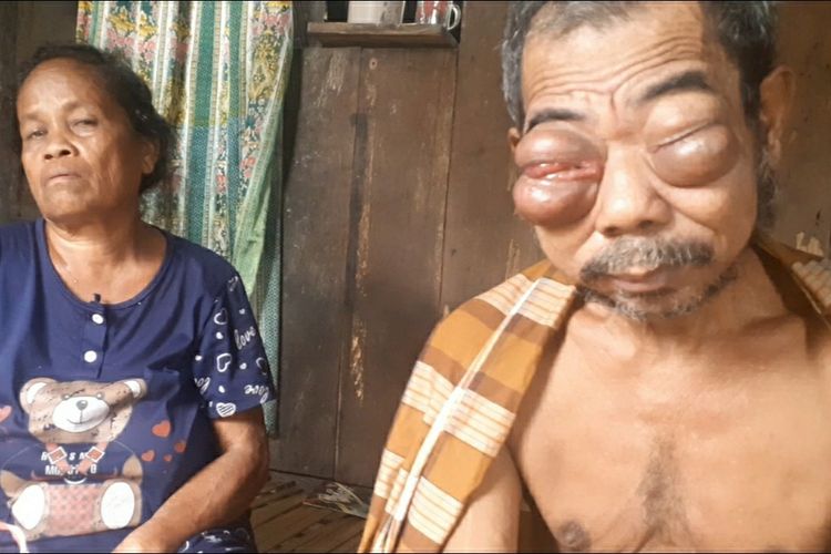 La Mauria (72) seorang petani asal Dusun Ulusadar, Desa Waesala, Kabupaten Seram Bagian Barat, Maluku ditemani isterinya hanya bisa pasrah dan berdoa agar pembengkakan mata yang membuatnya buta segera sembuh,