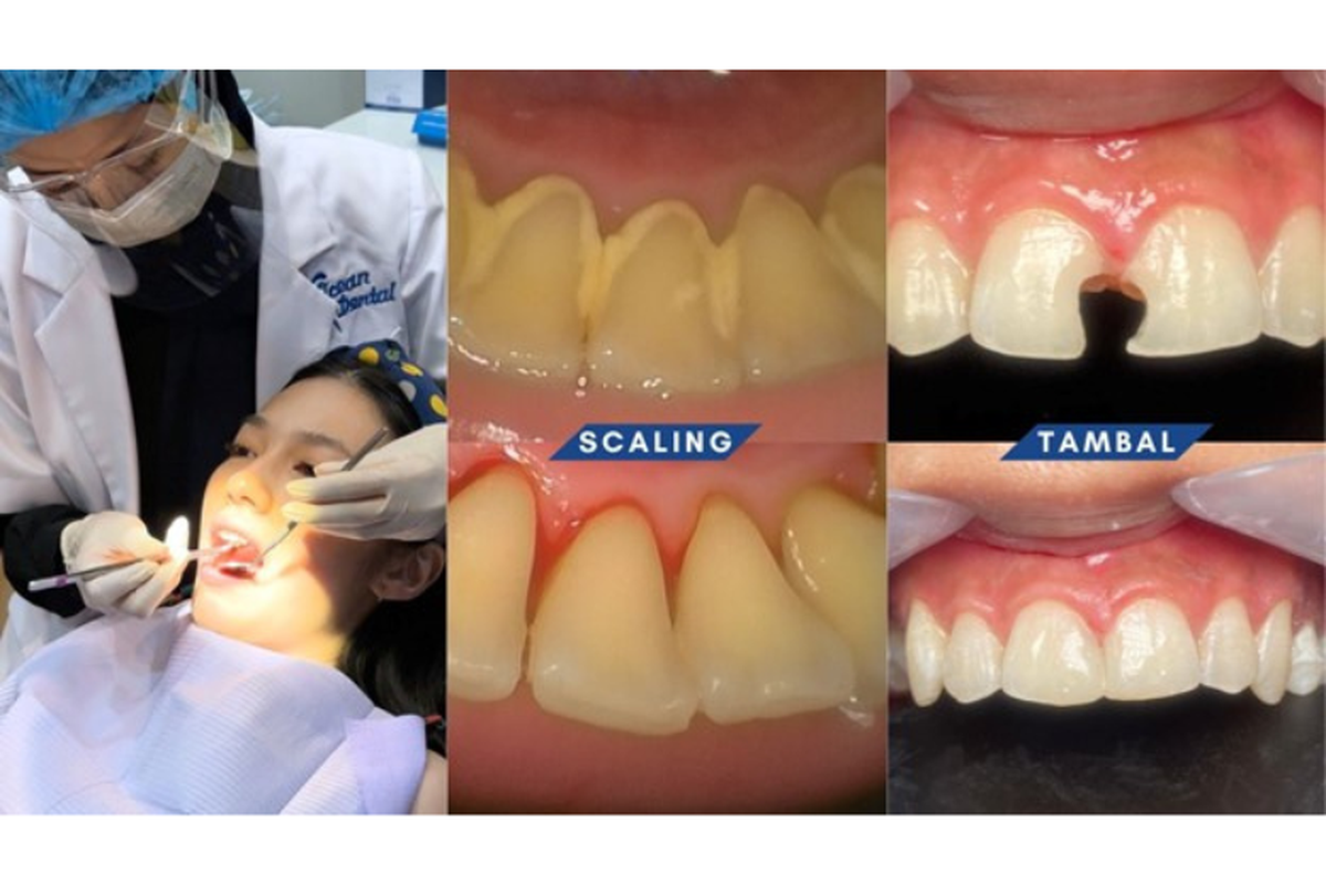 Beberapa contoh perawatan gigi di Ocean Dental.