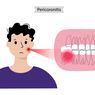 Perikoronitis 