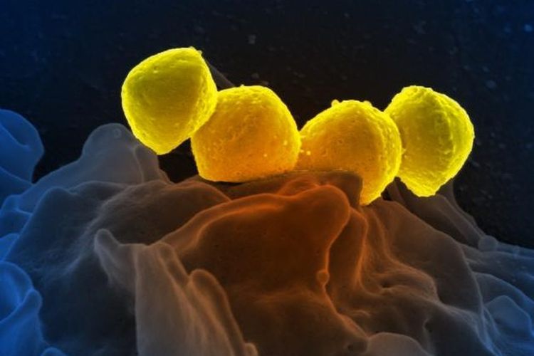 Ilustrasi bateri Streptococcus pyogenes. Streptococcal toxic shock syndrome adalah penyakit akibat infeksi bakteri Streptococcus pyogenes yang disertai syok mendadak dan kegagalan organ.