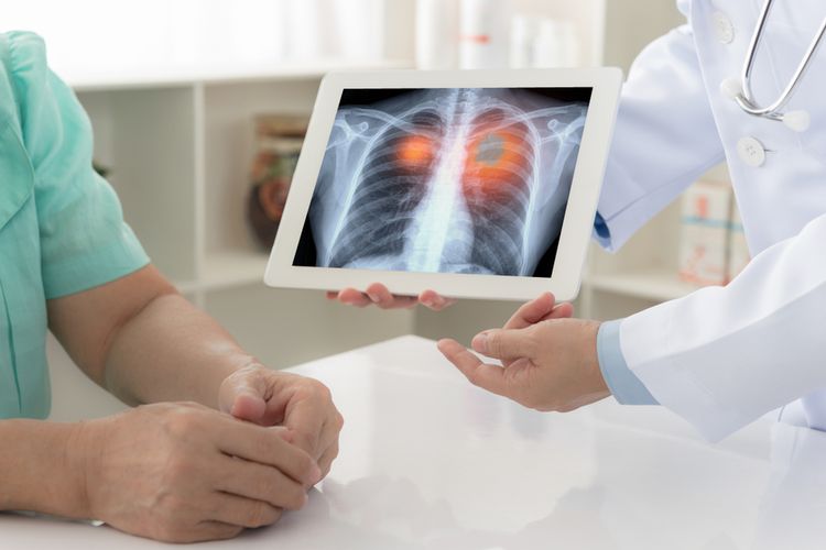 Jenis Skrining Kanker yang Direkomendasikan Dokter