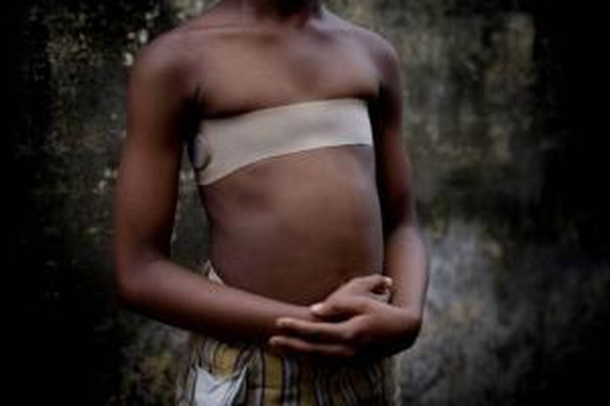 Budaya setrika payudara di AFrika yang bertujuan untuk menghindari anak perempuan menjadi korban pemerkosaan. 