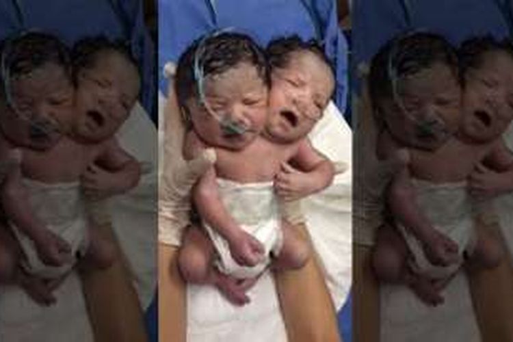 Bayi kembar siam di Meksiko lahir dengan dua kepala dalam satu tubuh.