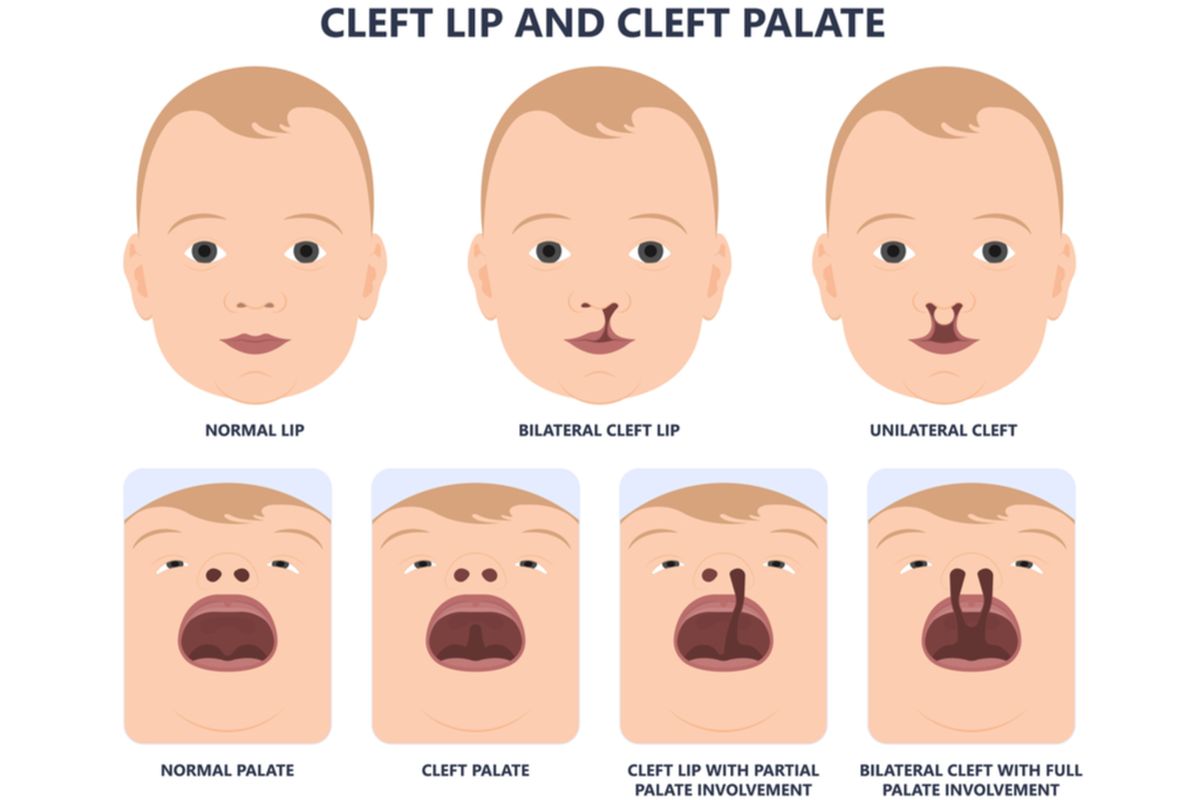 Ilustrasi bibir sumbing dan sumbing langit-langit