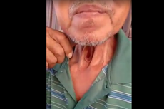Viral Video Bapak dengan Tenggorokan Berlubang Akibat Rokok, Ini Kata Dokter