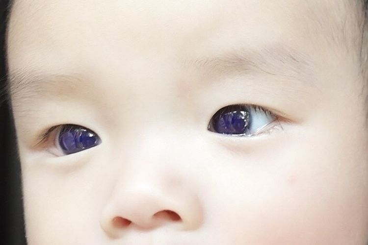 Saat Mata Seorang Bayi di Thailand Berubah Jadi Biru Usai Jalani Terapi Covid-19...